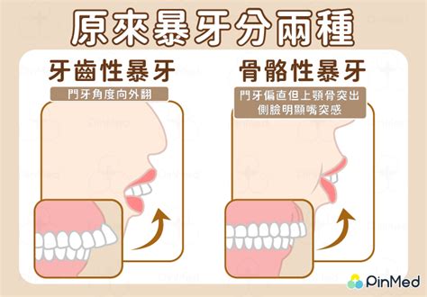 門牙暴牙面相